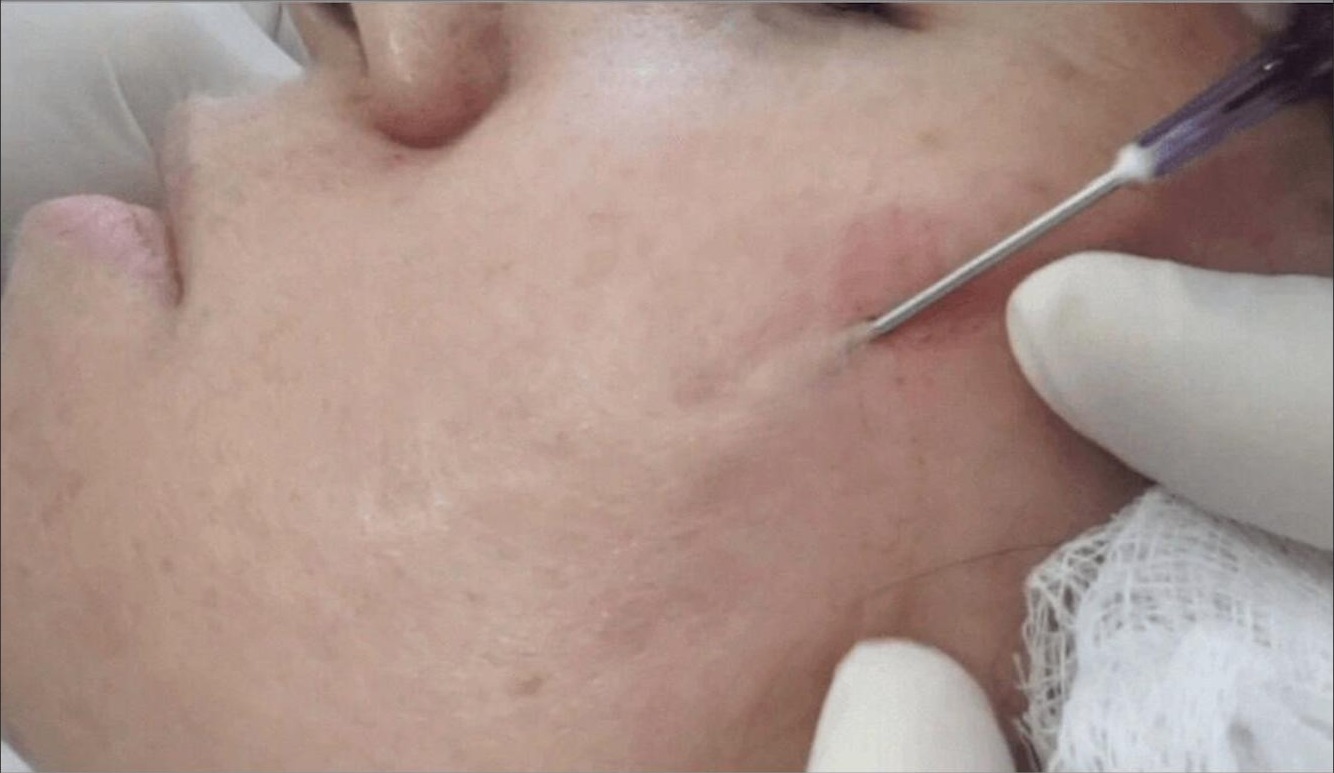 Acne Scar Treatment