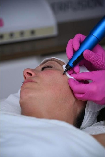 Cryosurgery