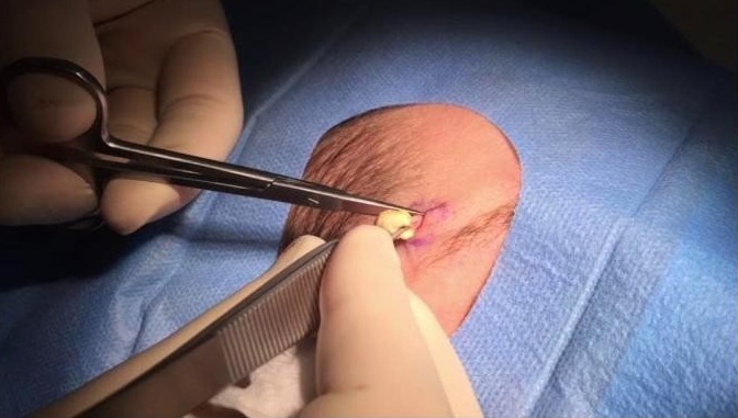 Cyst Removal