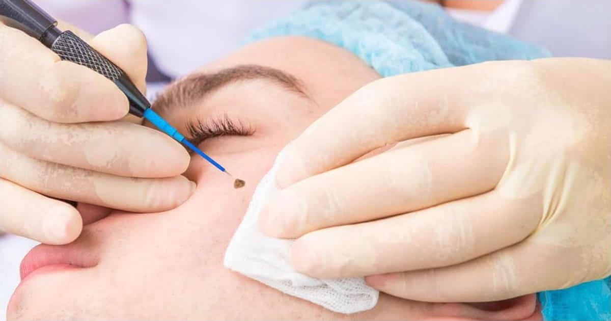 Electrocautery