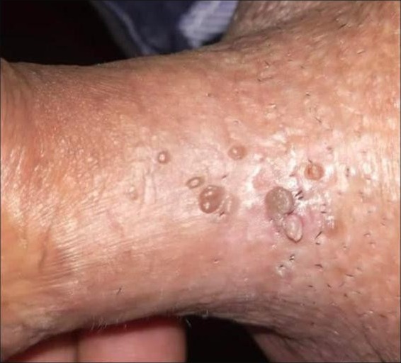 Genital Warts Removal