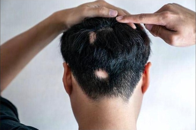 Hair Loss Treatment