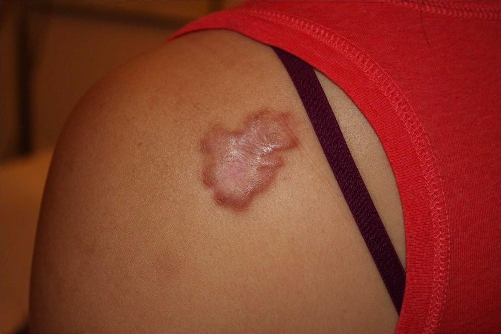 Keloid Treatment