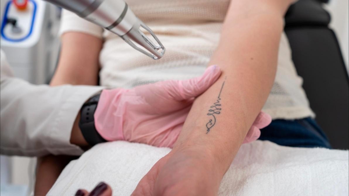 Laser Tattoo Removal