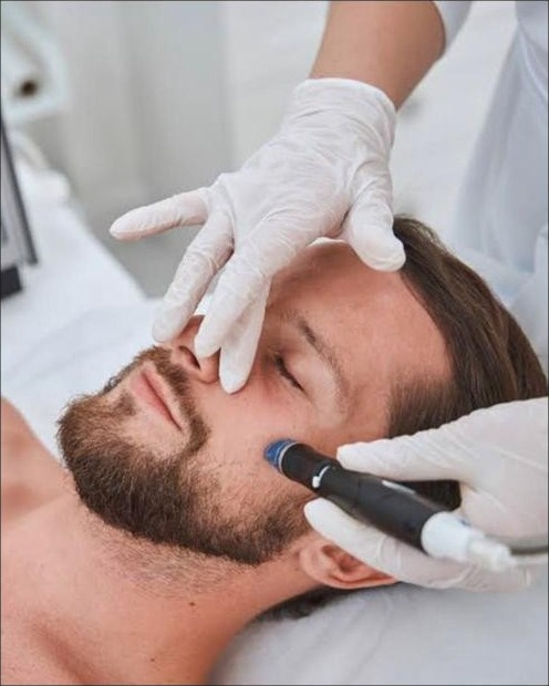 Microneedling HA