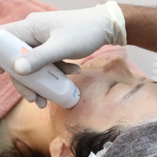 RF Treatment