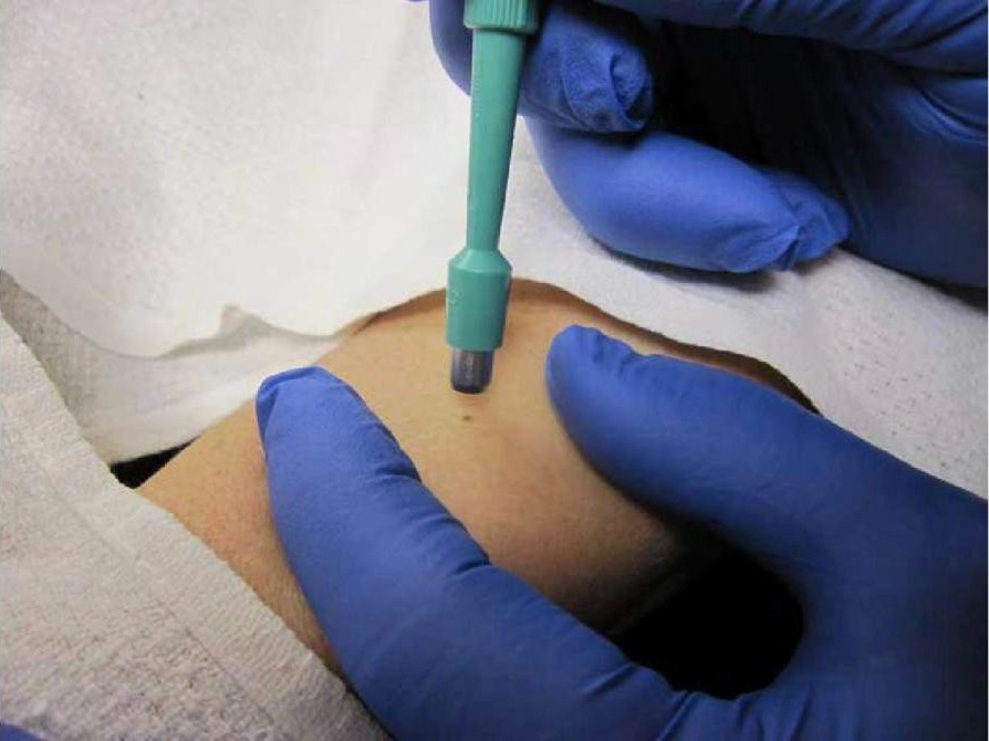 Skin Punch Biopsy